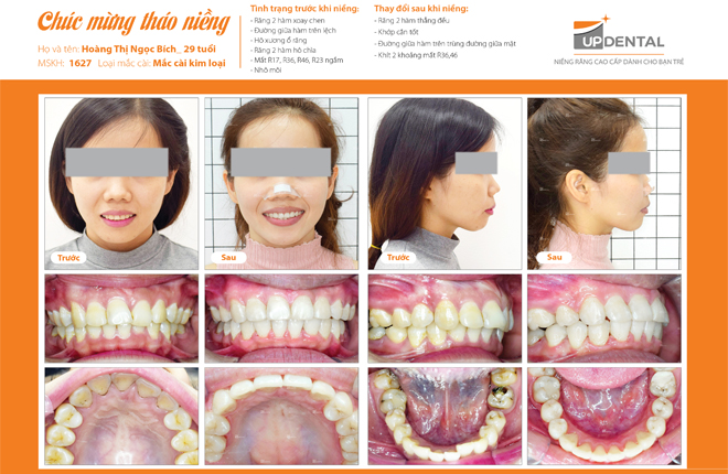 Ảnh trước và sau khi niềng