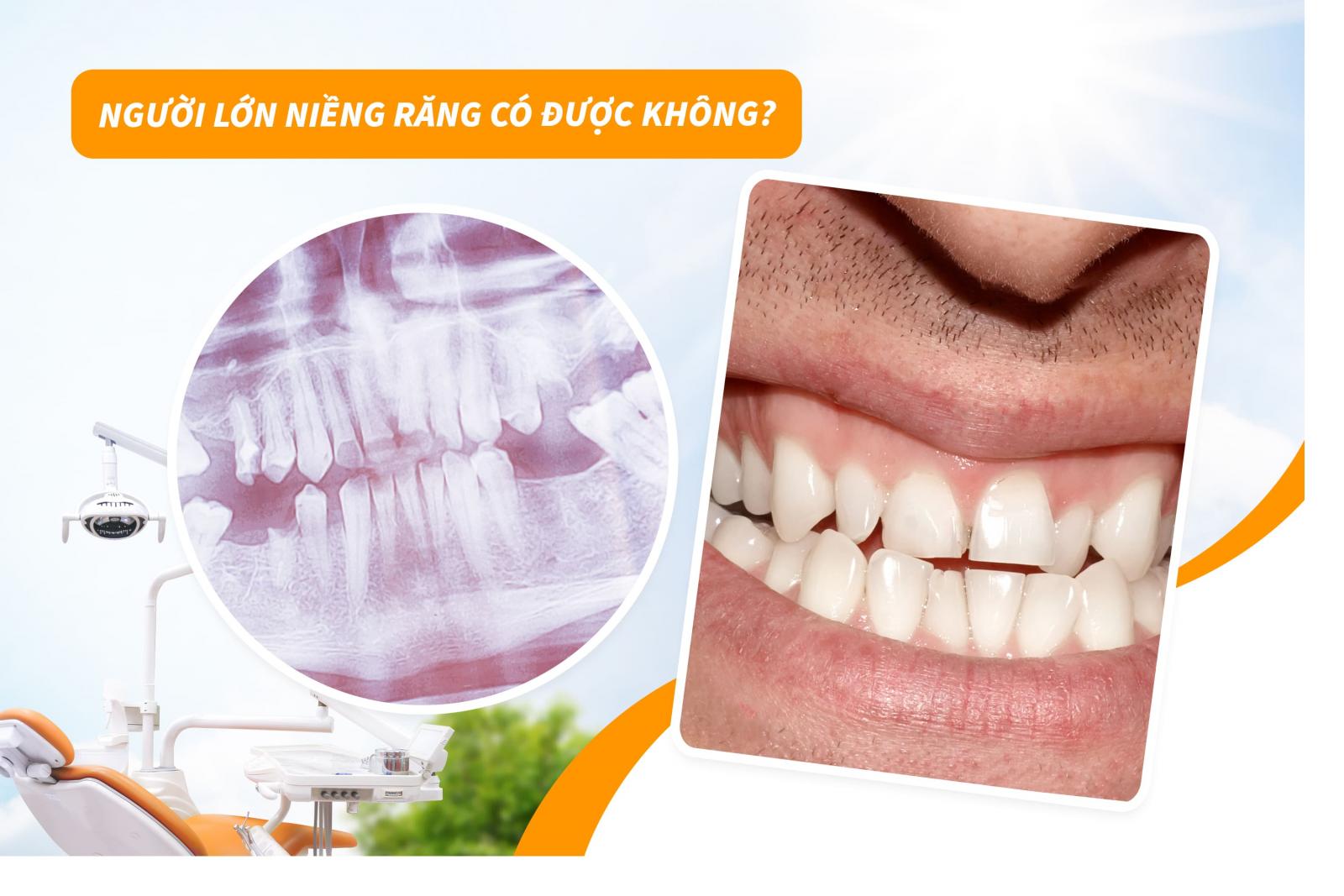 Người lớn niềng răng có được không?