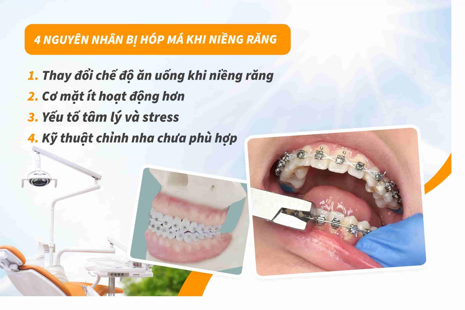 Nguyên nhân bị hóp má khi niềng răng