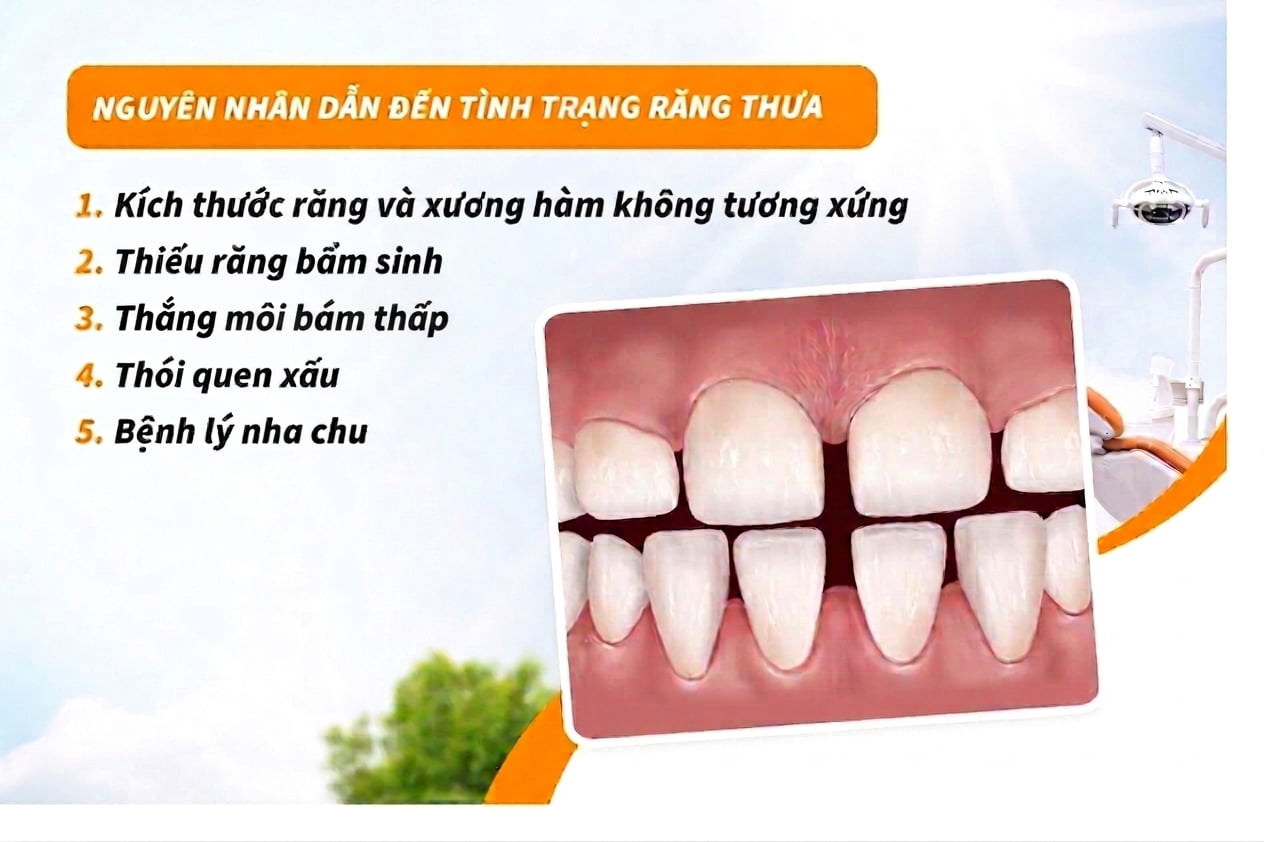 Nguyên nhân dẫn đến tình trạng răng thưa