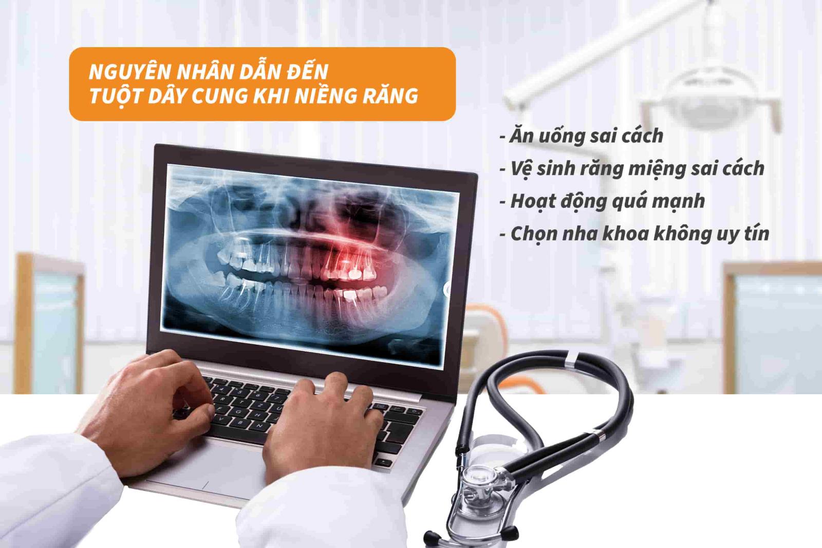 Nguyên nhân dẫn đến tuột dây cung khi niềng răng 