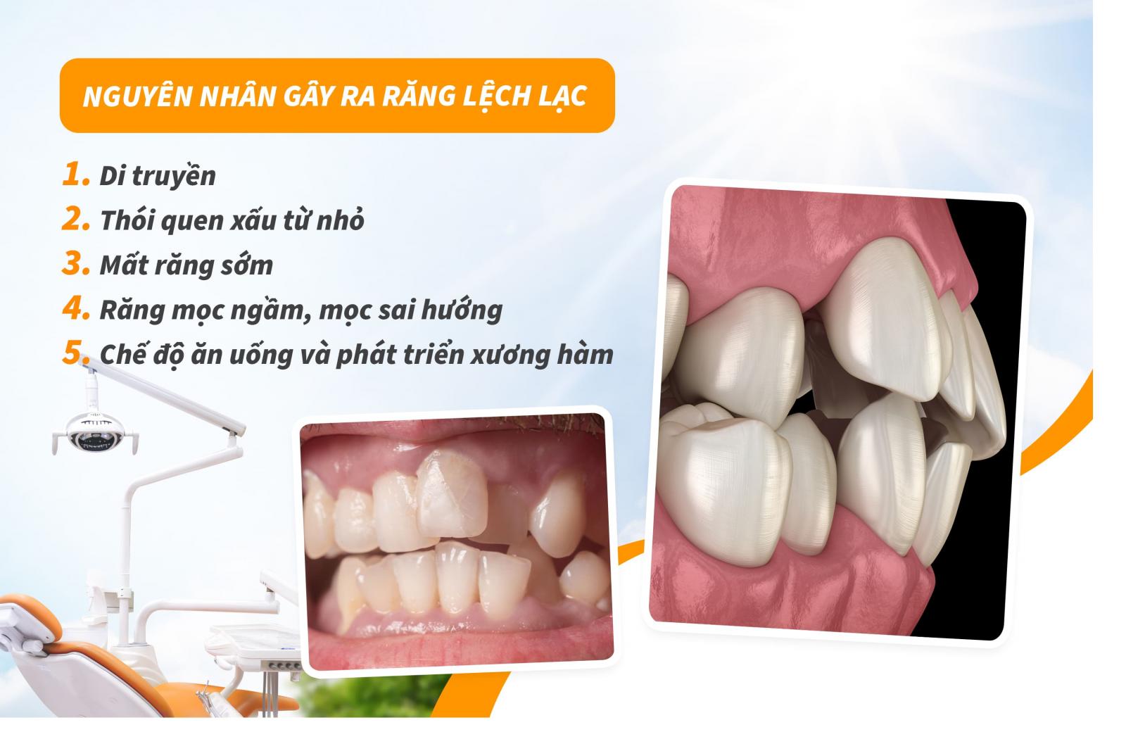 Nguyên nhân gây ra răng lệch lạc