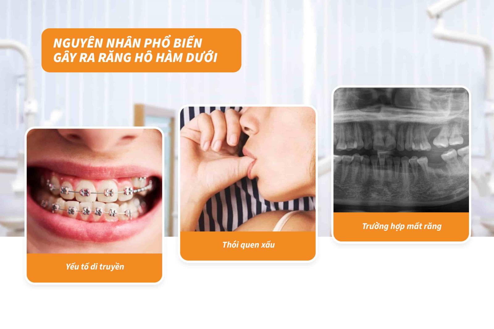 Nguyên nhân phổ biến gây ra răng hô hàm dưới