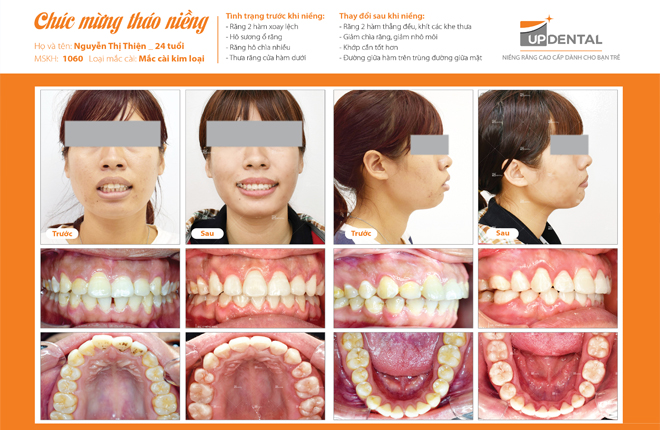 Ảnh trước và sau khi niềng răng