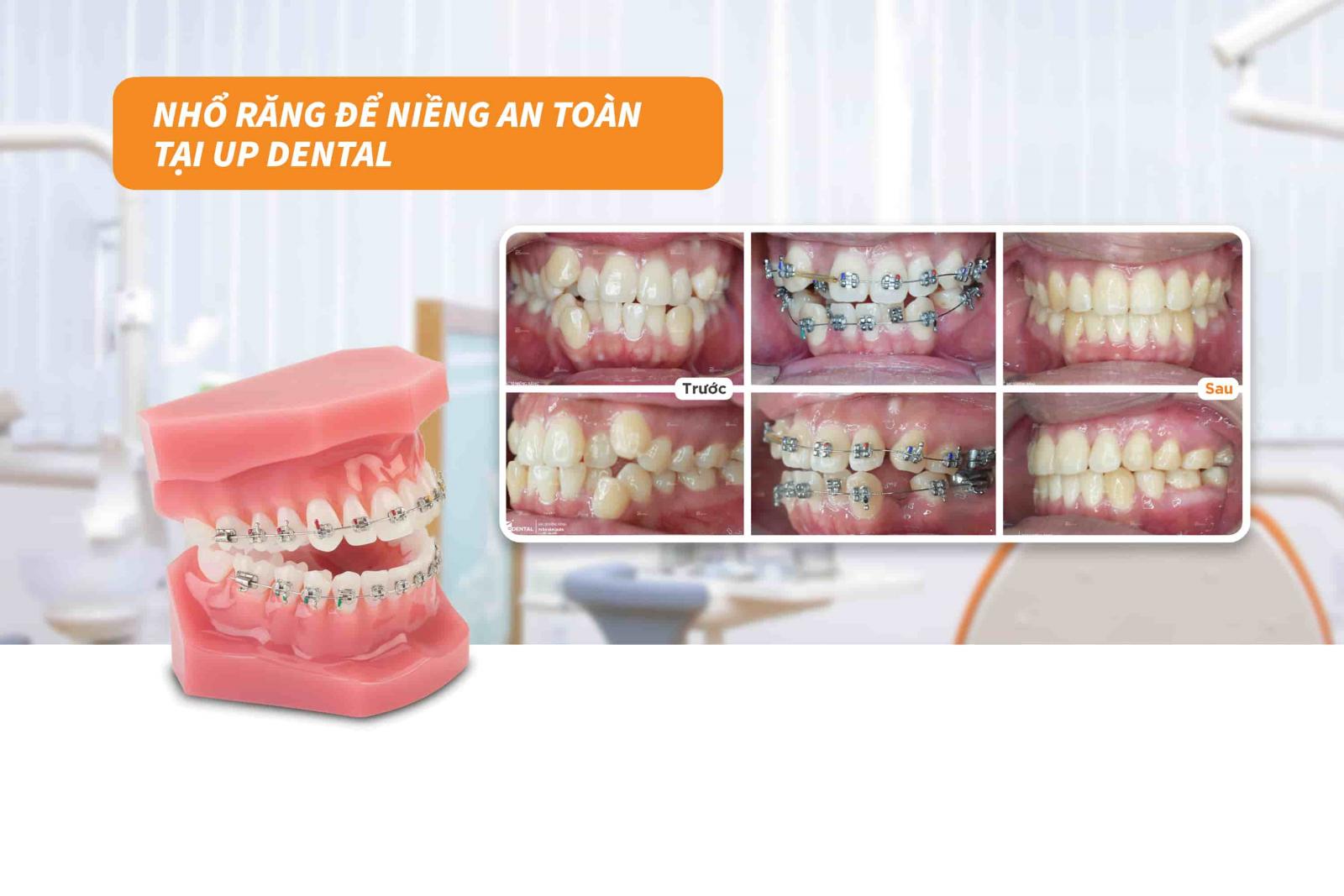 Nhổ răng để niềng an toàn tại Up Dental 