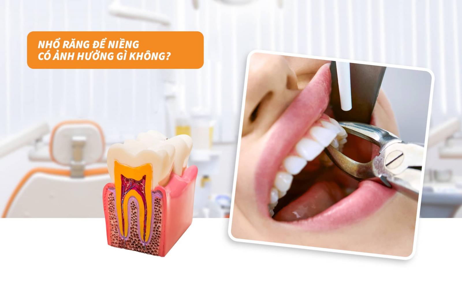 Nhổ răng để niềng có ảnh hưởng gì không?