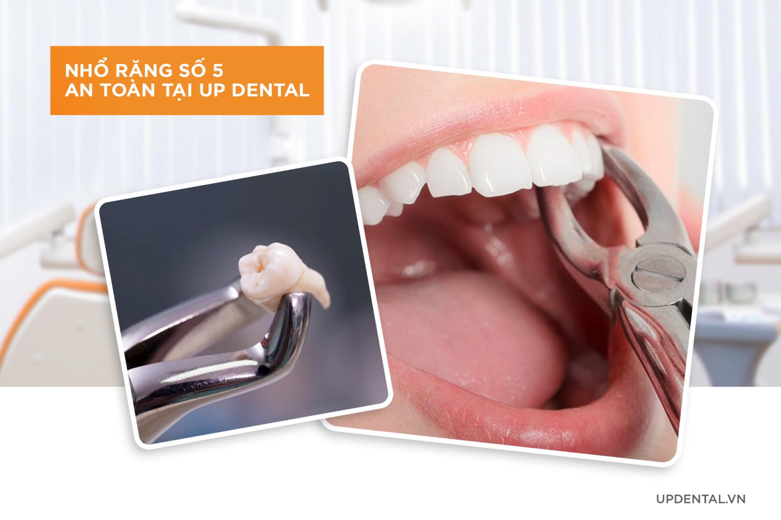 Nhổ răng số 5 khi niềng răng an toàn tại Up Dental