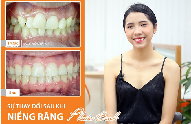 nhung-luu-y-khi-nieng-rang