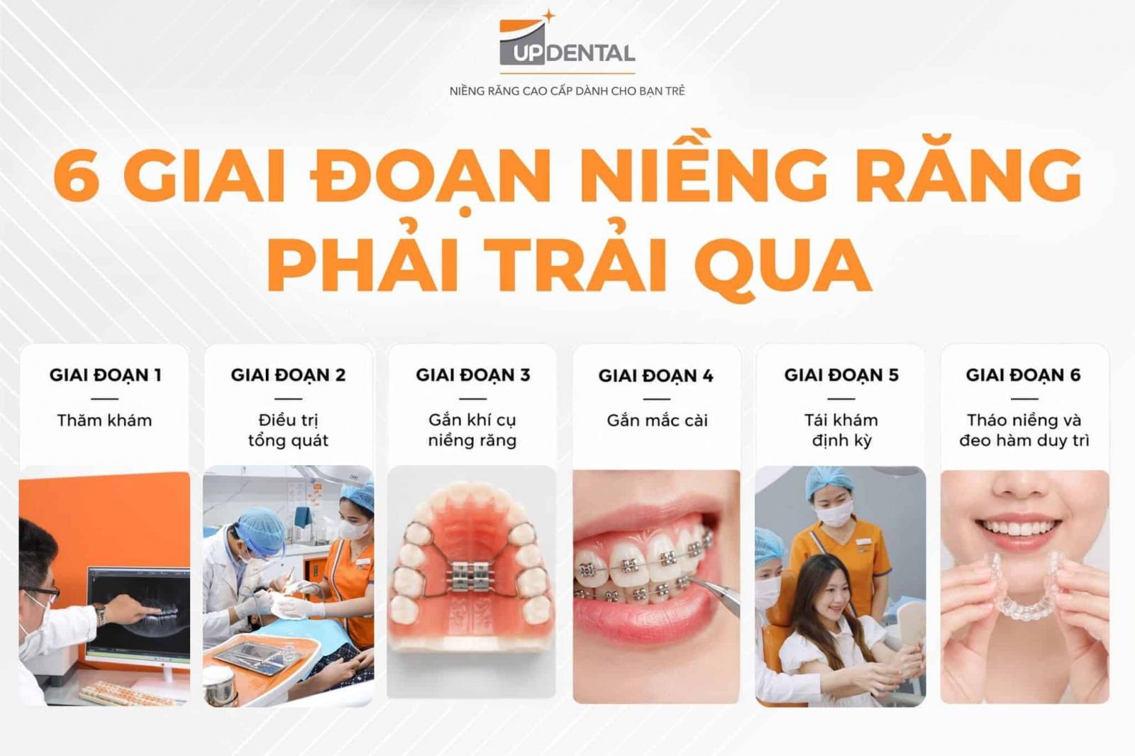 6 giai đoạn niềng răng phải trải qua