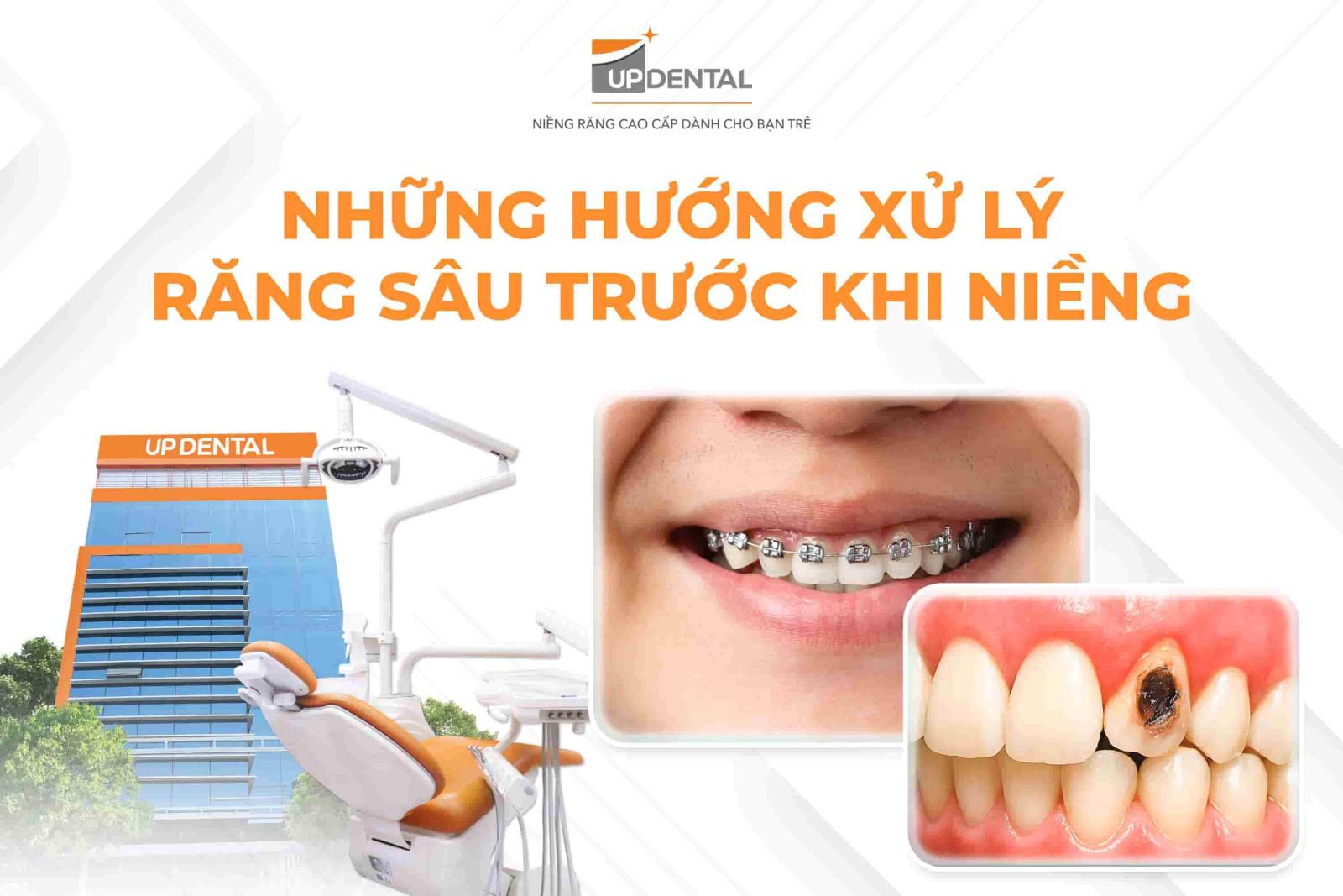 Những hướng xử lý răng sâu trước khi niềng
