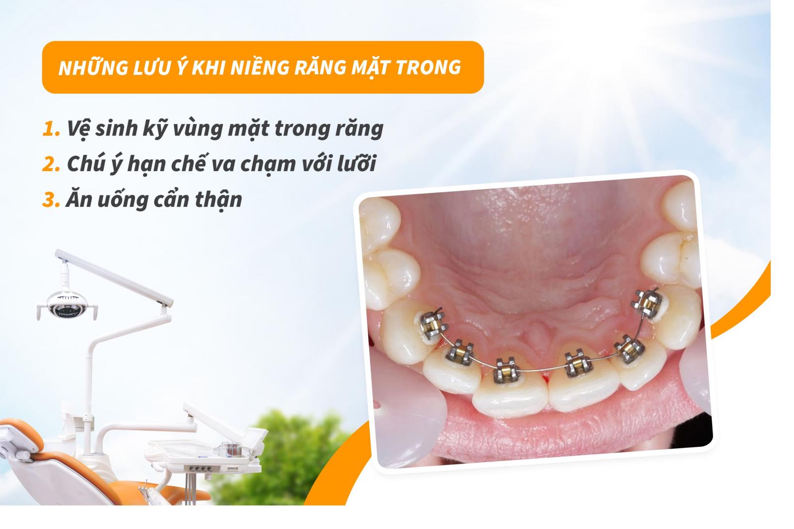 Những lưu ý khi niềng răng mặt trong