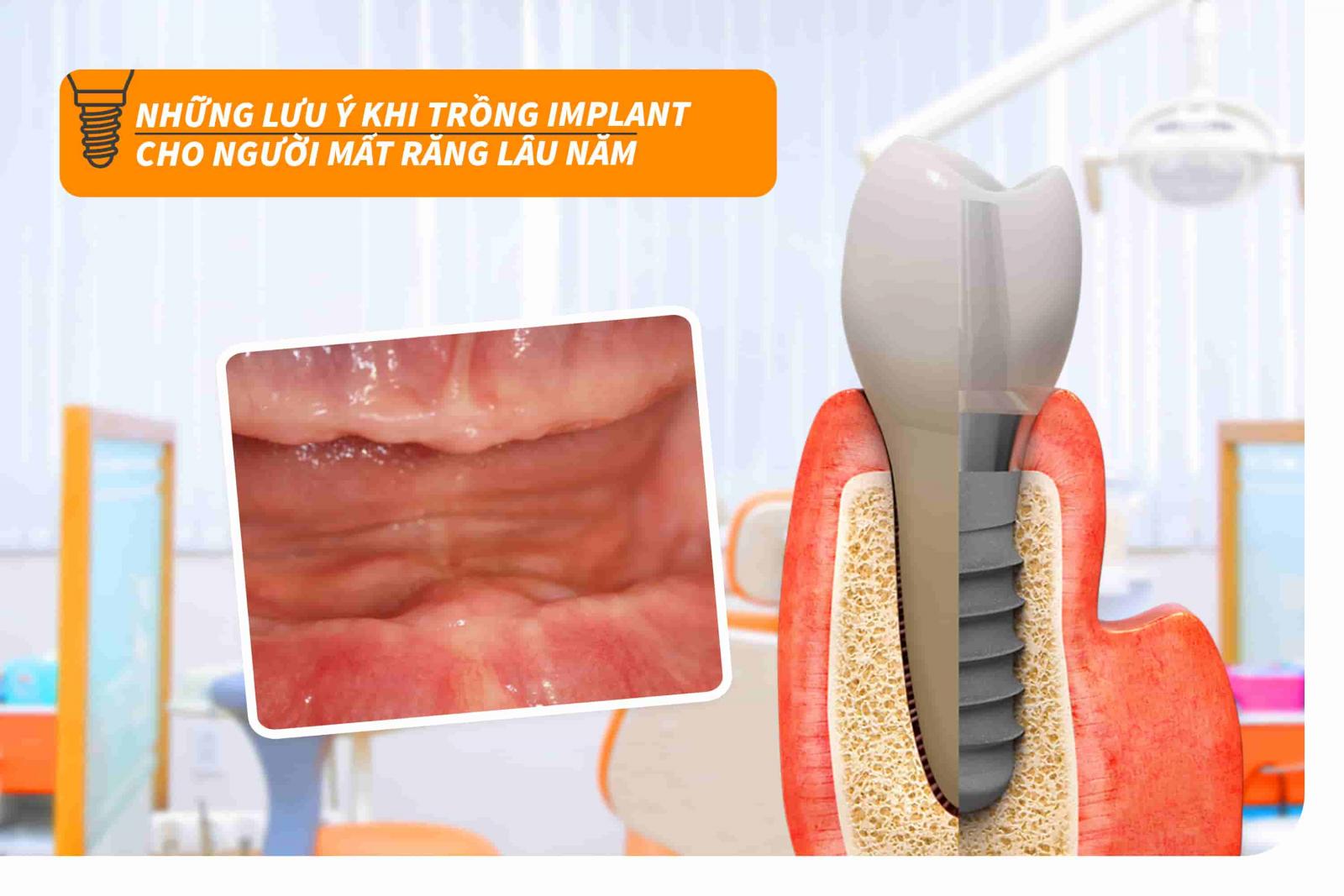 Những lưu ý khi trồng Implant cho người mất răng lâu năm