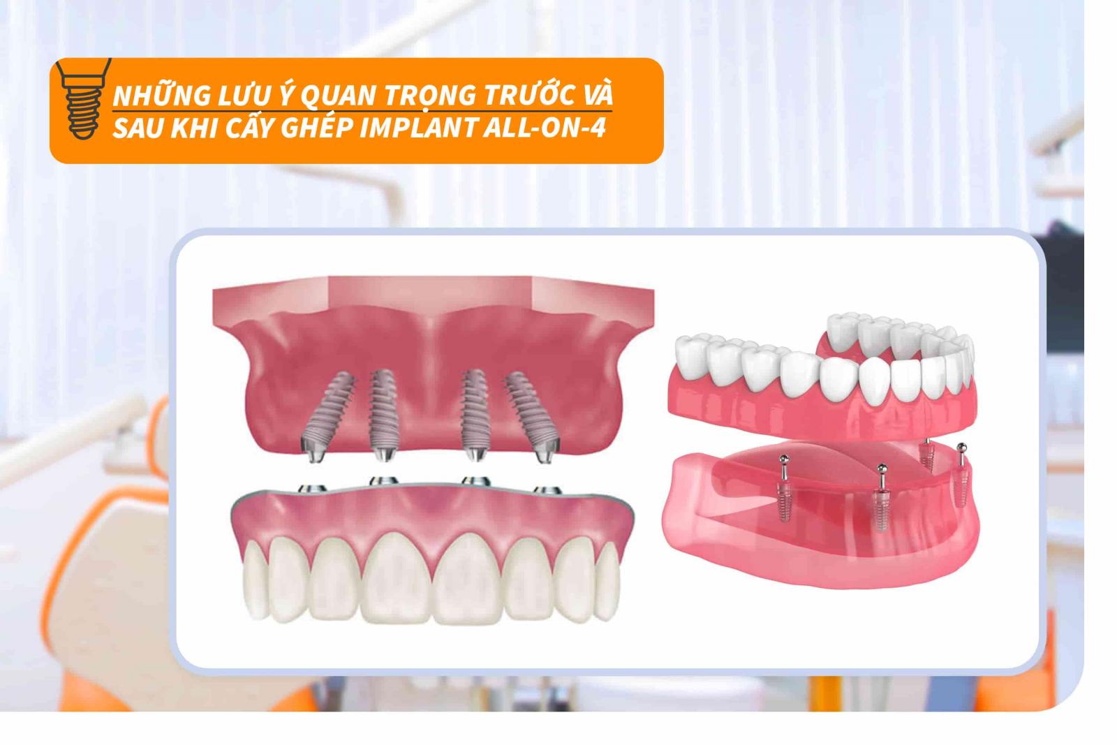Những lưu ý quan trọng trước và sau khi cấy ghép Implant All-on-4