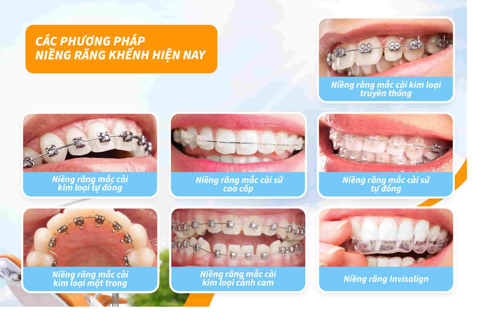 7 phương pháp niềng răng khấp khểnh phổ biến hiện nay