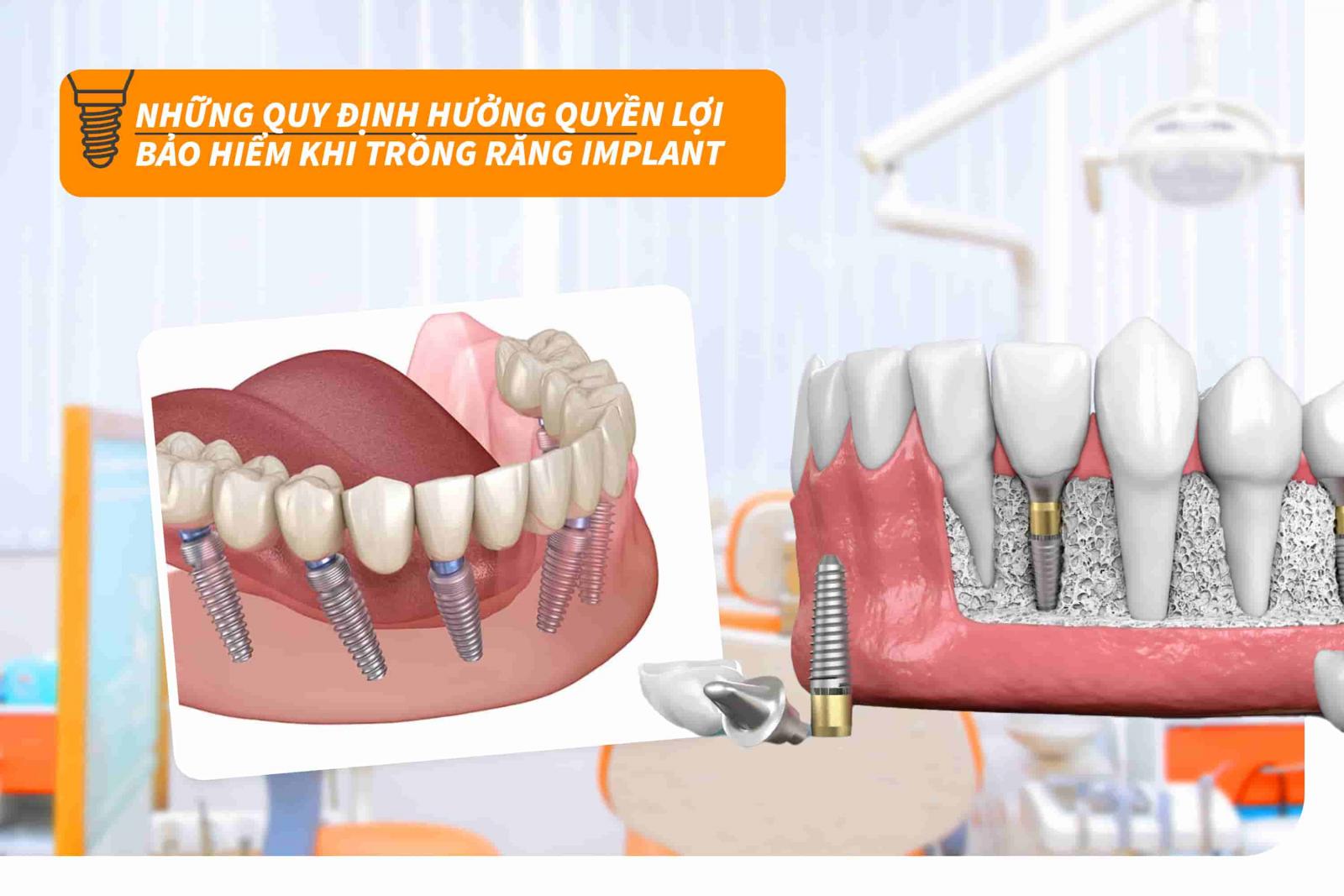 Những quy định hưởng quyền lợi bảo hiểm khi trồng răng Implant
