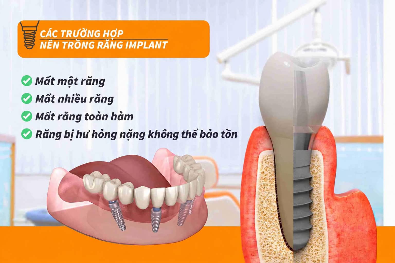 Các trường hợp nên trồng răng Implant