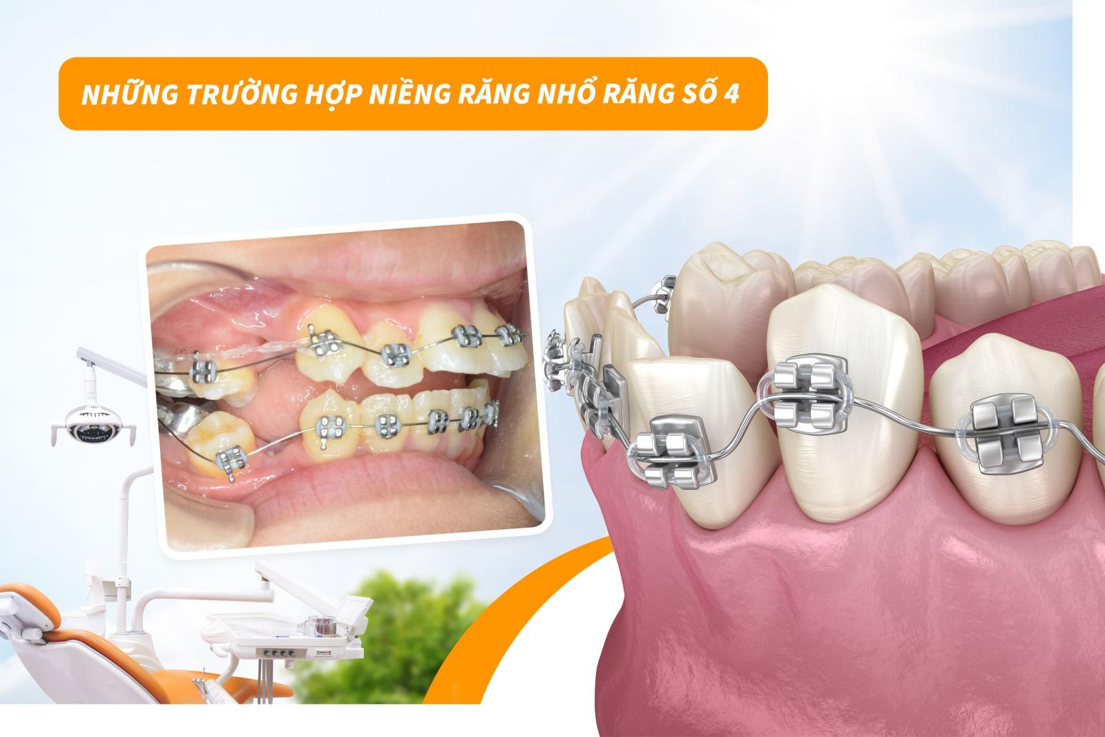Những trường hợp niềng răng nhổ răng số 4