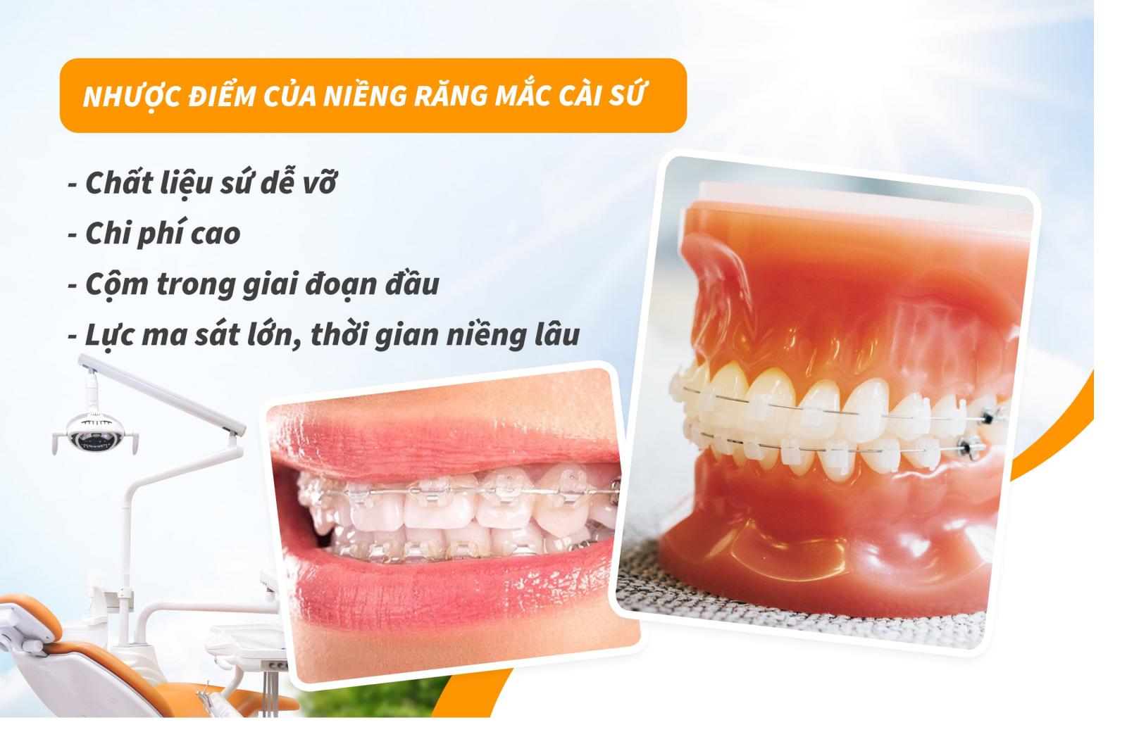 Nhược điểm của niềng răng mắc cài sứ