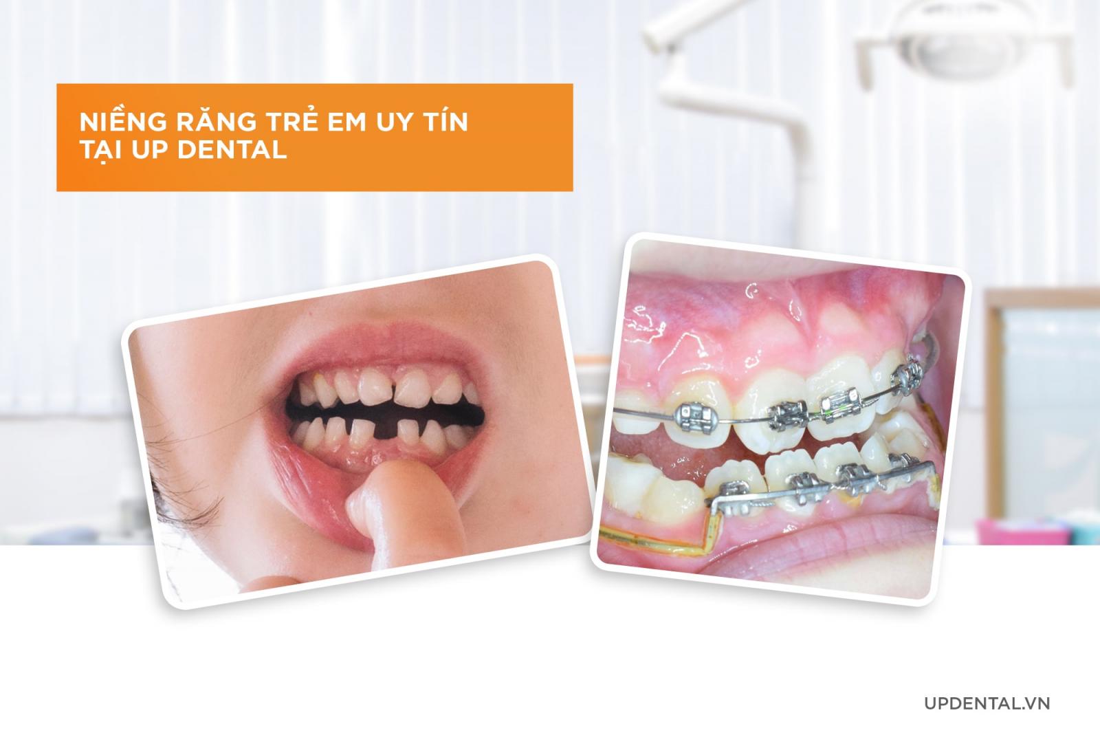 niềng răng cho trẻ em uy tín tại Up Dental