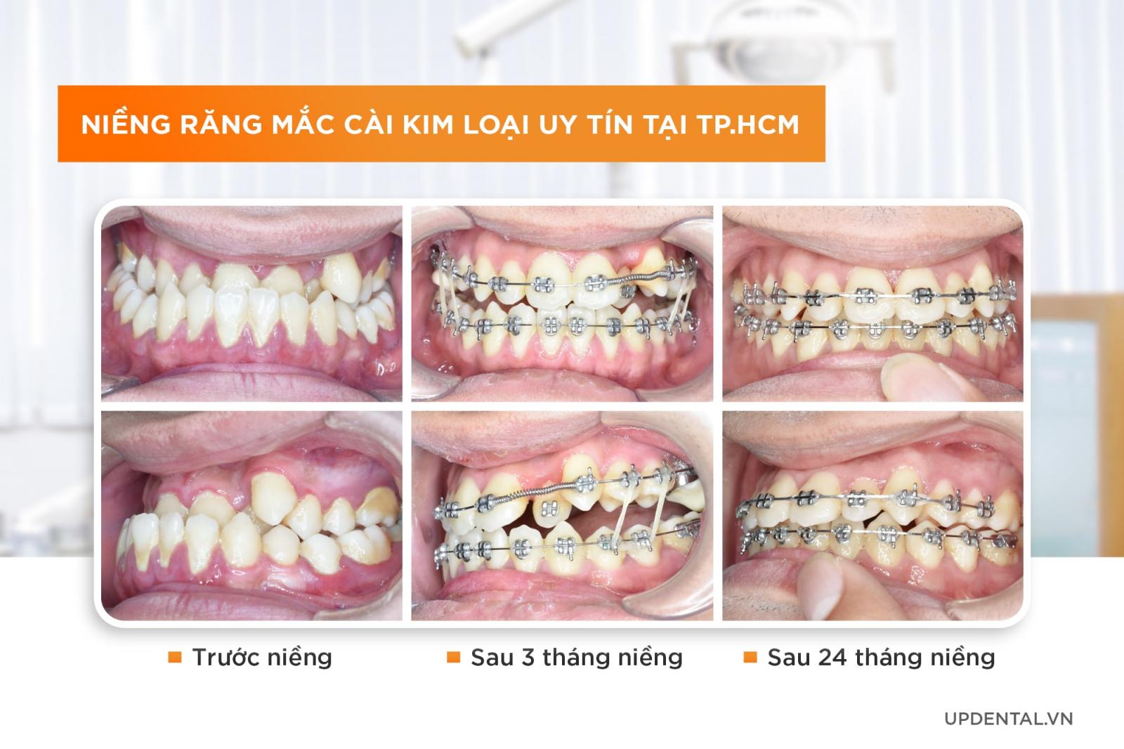 niềng răng mắc cài kim loại thường uy tín tại tphcm