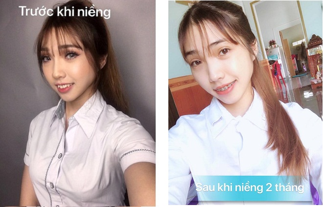nieng rang khenh sau 2 thang
