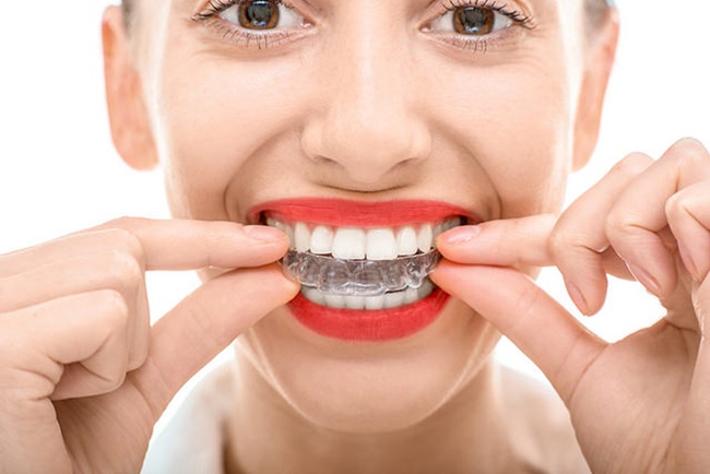 nieng-rang-khong-mac-cai-clear aligner