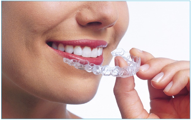 nieng-rang-khong-mac-cai-clear aligner