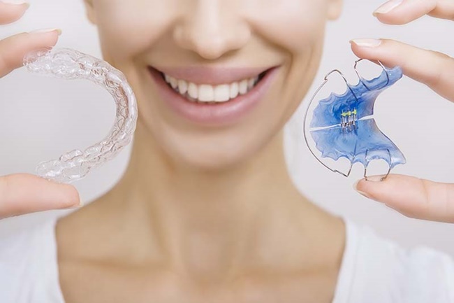 nieng-rang-khong-mac-cai-clear aligner