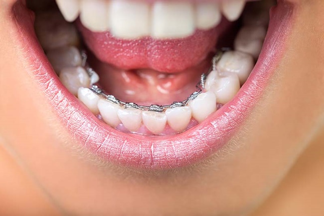 Niềng răng mắc cài mặt trong