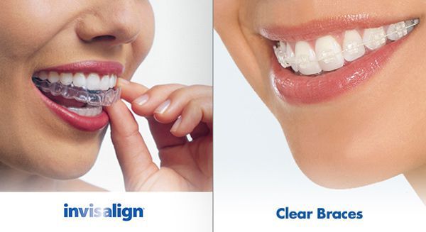 Nieng rang khong mac cai tra gop tai Up Dental