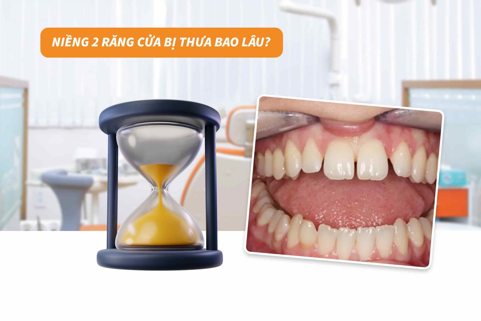 Niềng 2 răng cửa bị thưa bao lâu? 