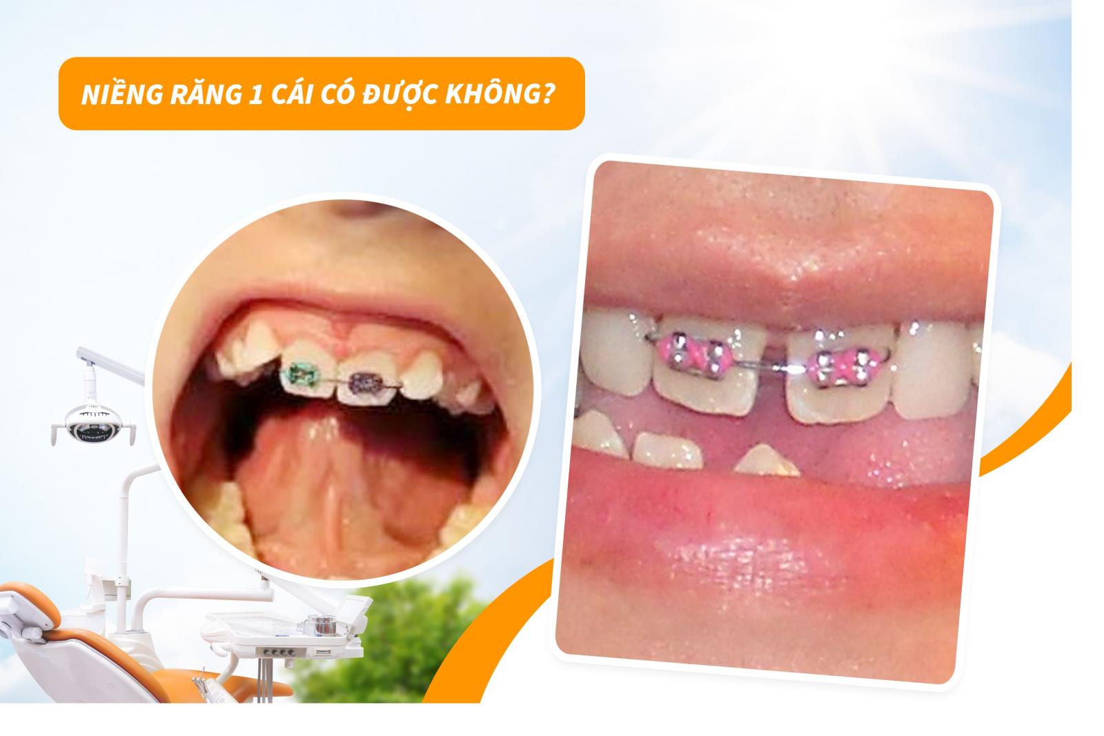 Niềng răng 1 cái có được không?