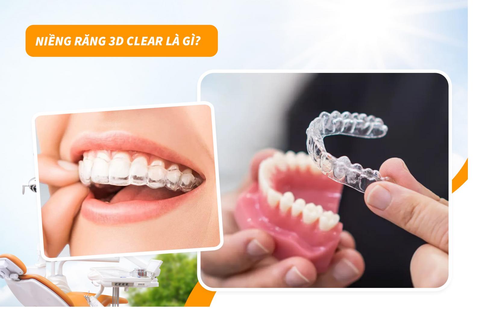 Niềng răng 3D Clear là gì?