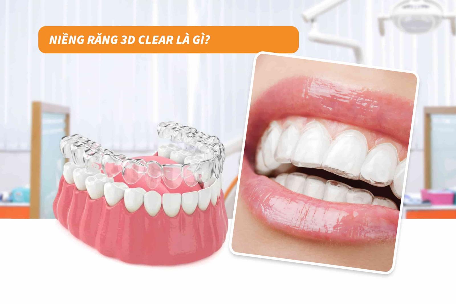 Niềng răng 3D Clear là gì?