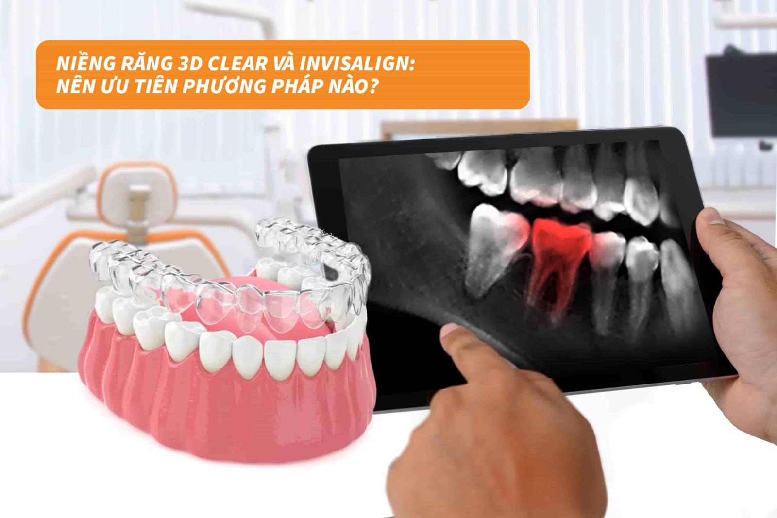 Niềng răng 3D Clear và Invisalign: Nên ưu tiên phương pháp nào?