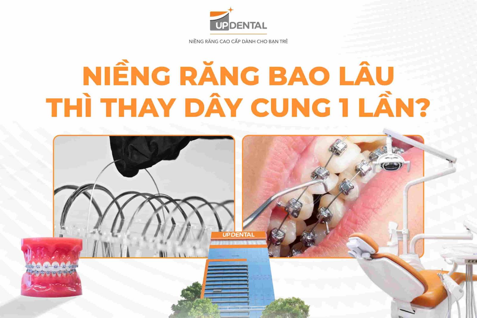Niềng răng bao lâu thì thay dây cung 1 lần?