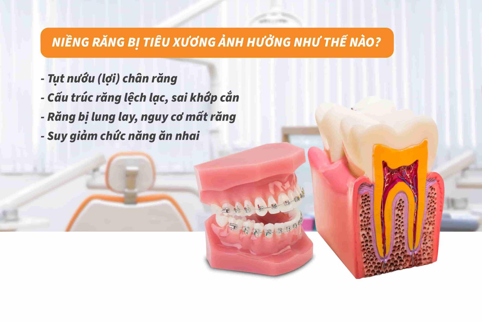 Niềng răng bị tiêu xương ảnh hưởng như thế nào?