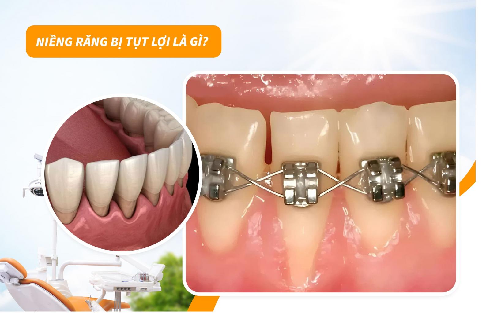 Niềng răng bị tụt lợi là gì?