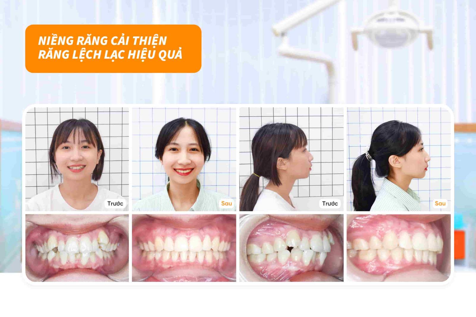 Niềng răng lệch lạc