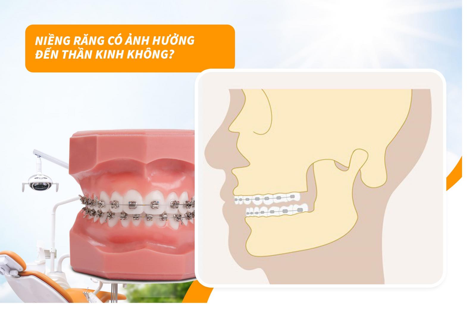 Niềng răng có ảnh hưởng đến thần kinh không?