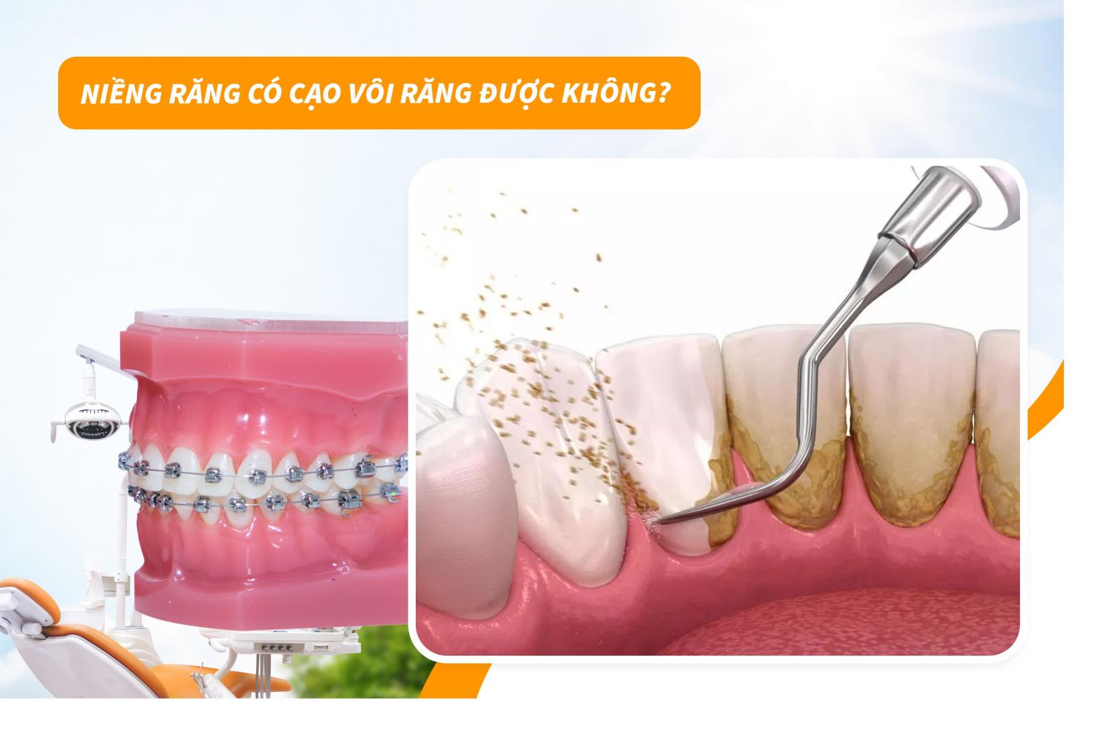 Niềng răng có cạo vôi răng được không?
