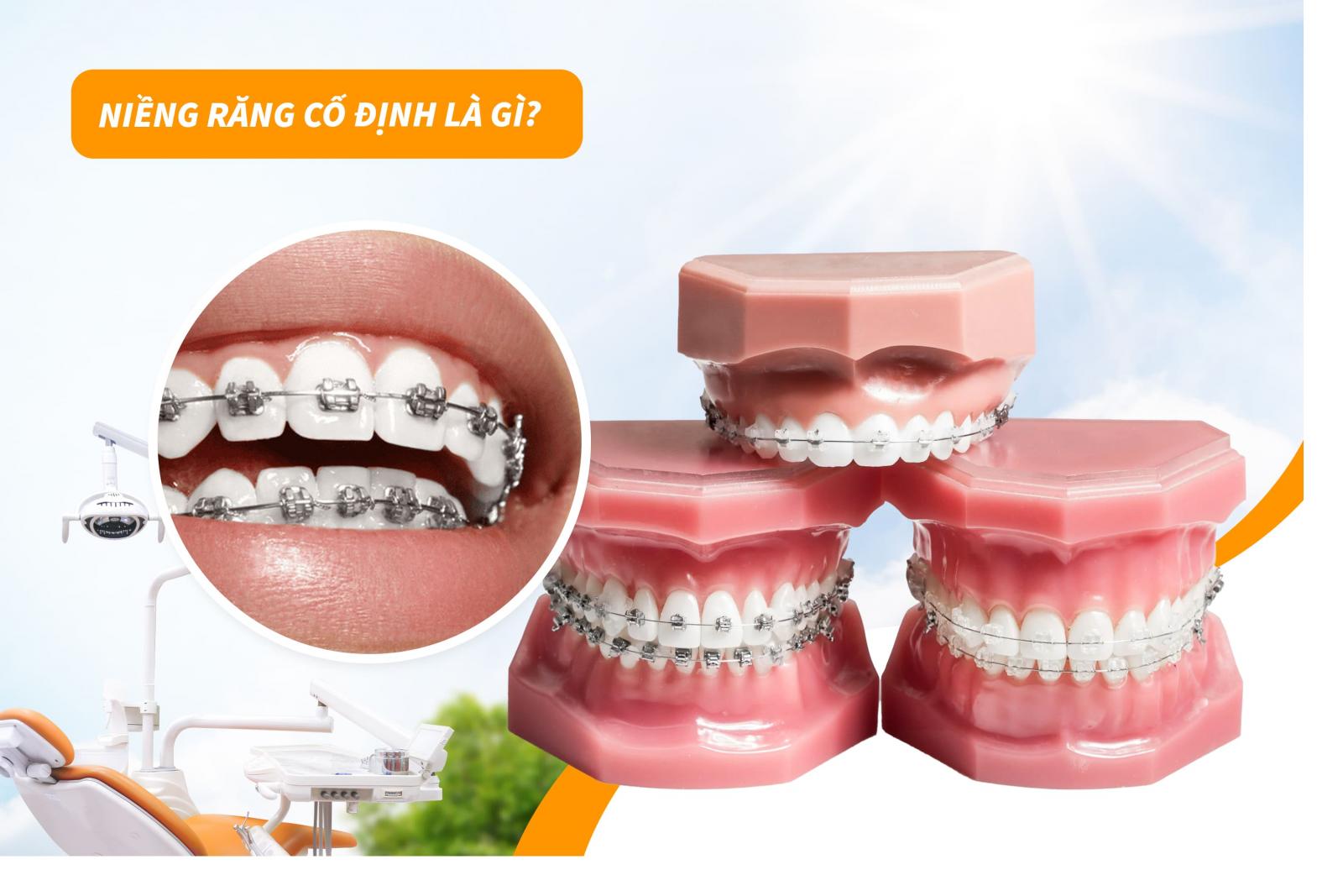Niềng răng cố định là gì?