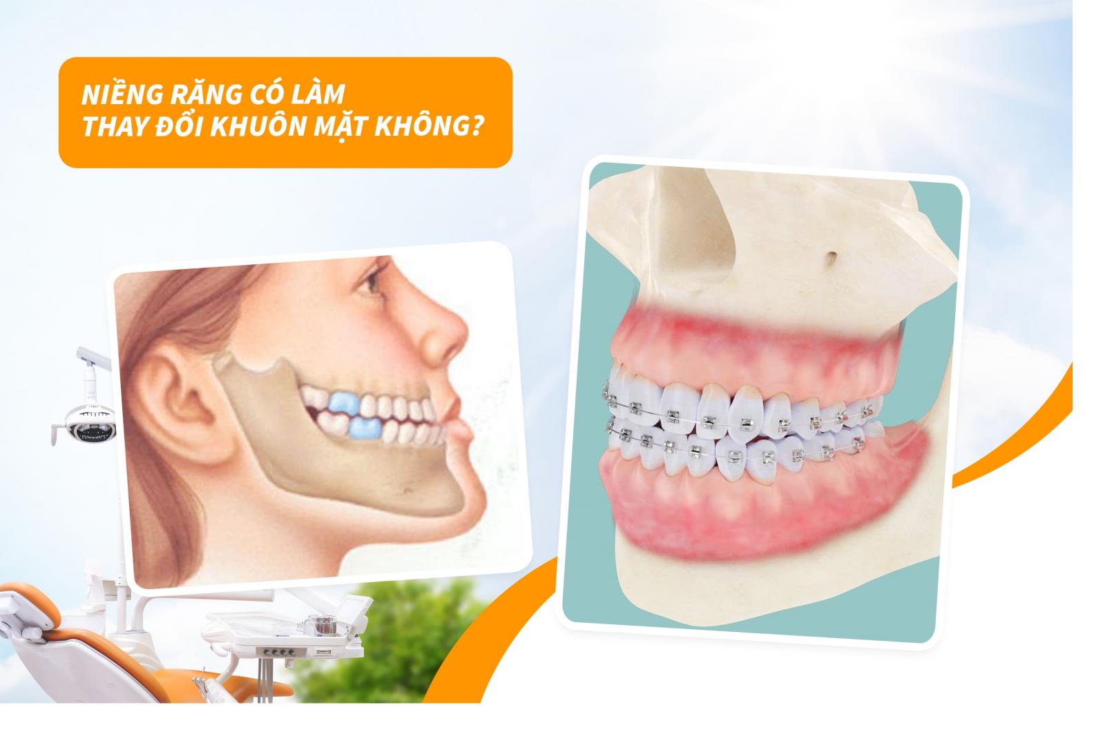 Niềng răng có làm thay đổi khuôn mặt không?