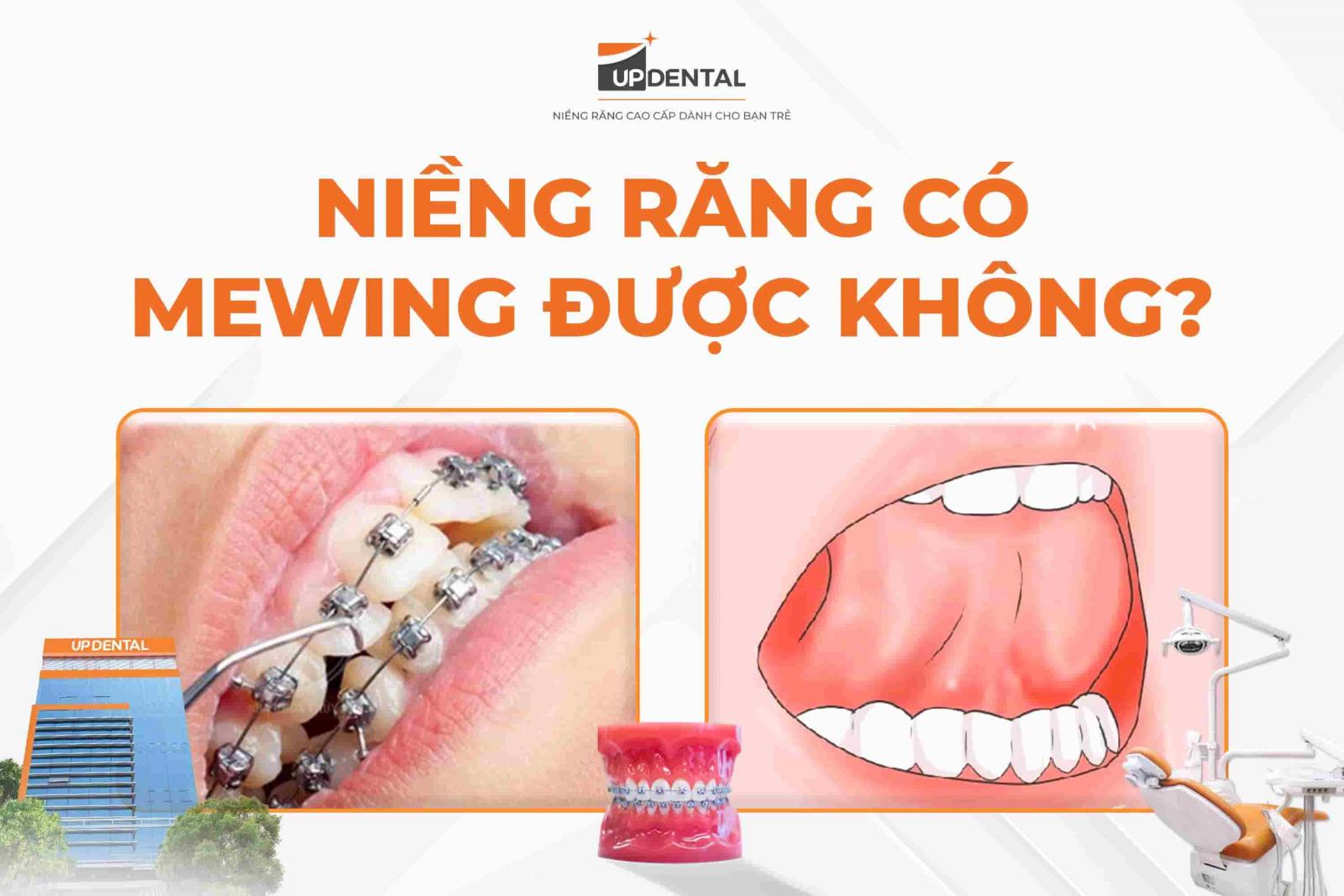 Niềng răng có mewing được không?
