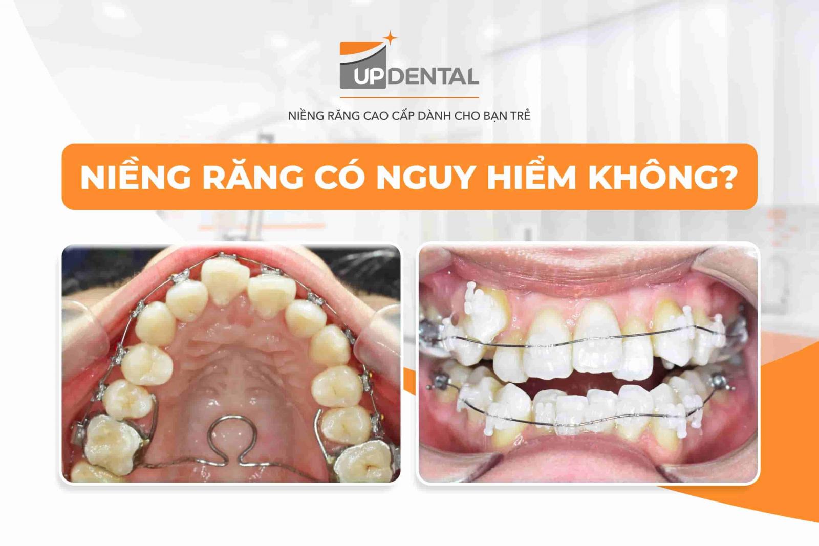 Niềng răng có nguy hiểm không?