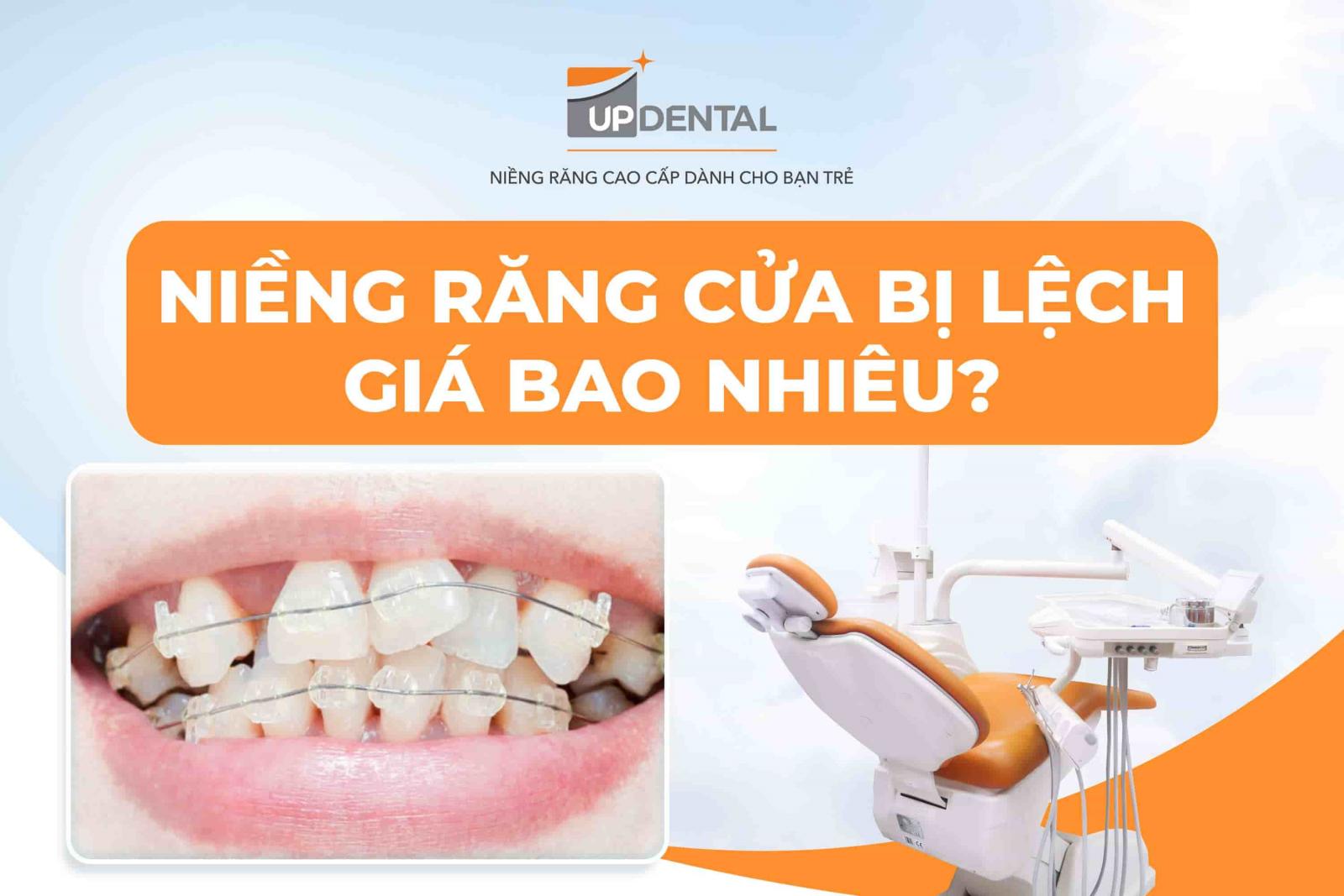 Niềng răng cửa bị lệch giá bao nhiêu?