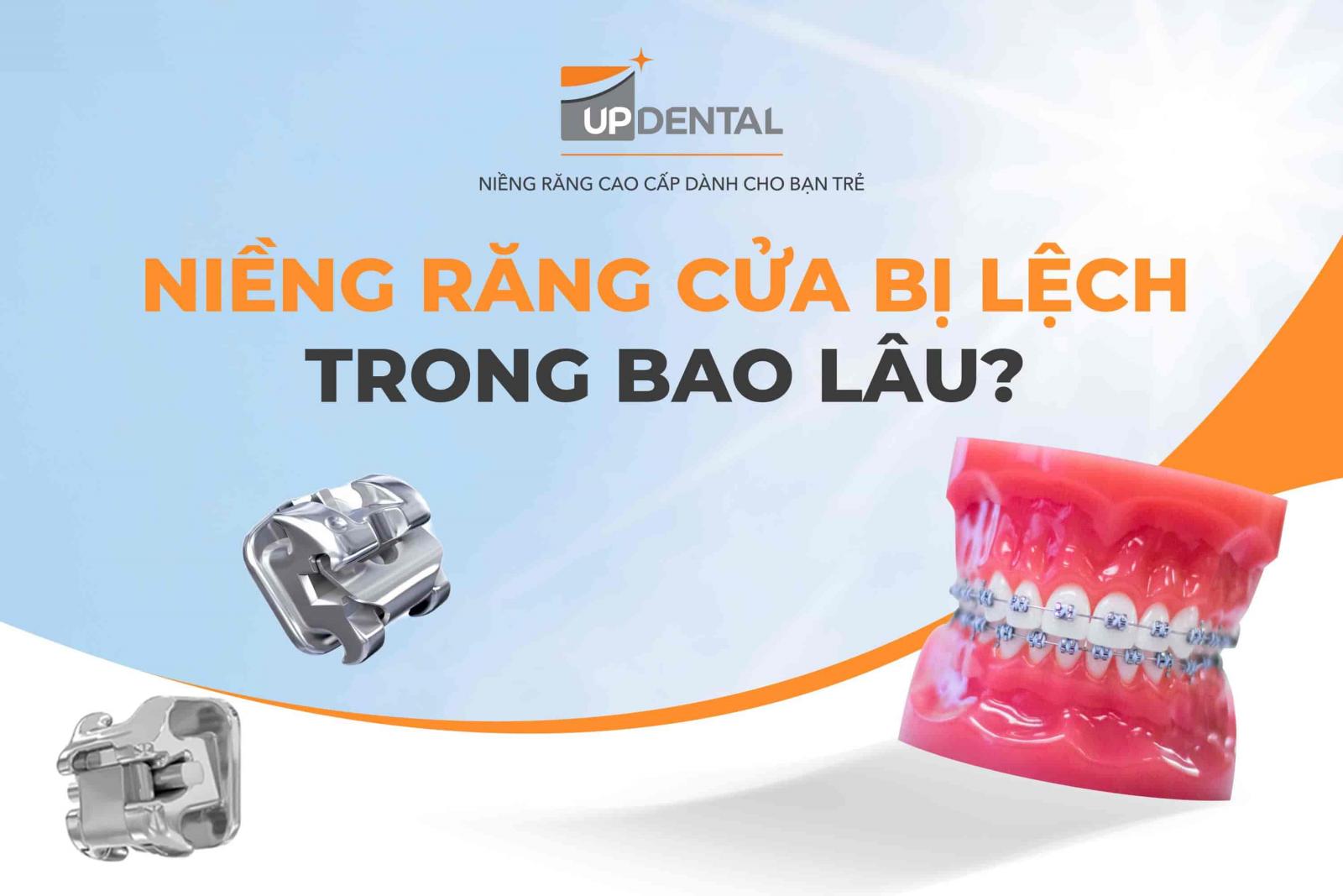 Niềng răng cửa bị lệch trong bao lâu?