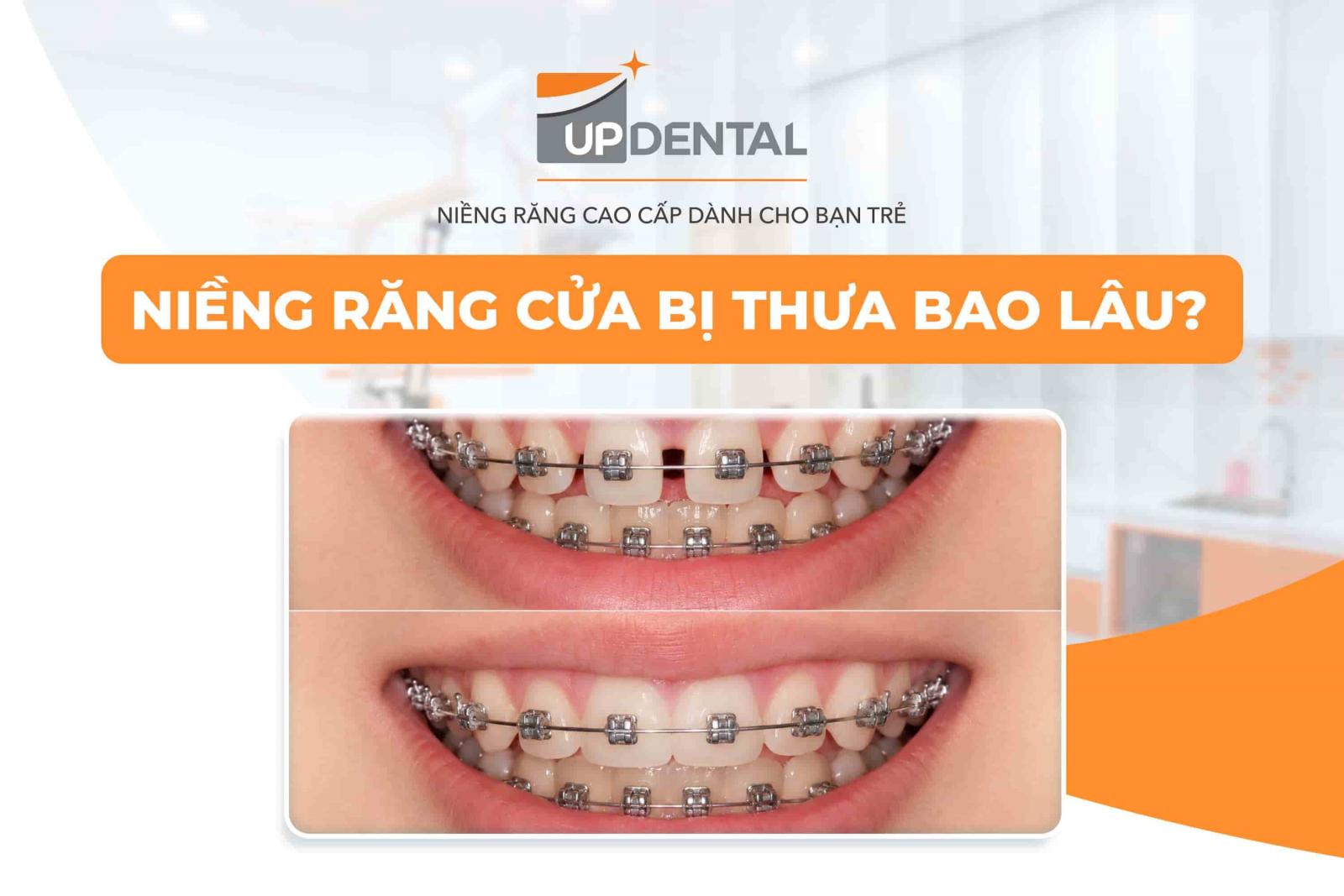 Niềng răng cửa bị thưa bao lâu?