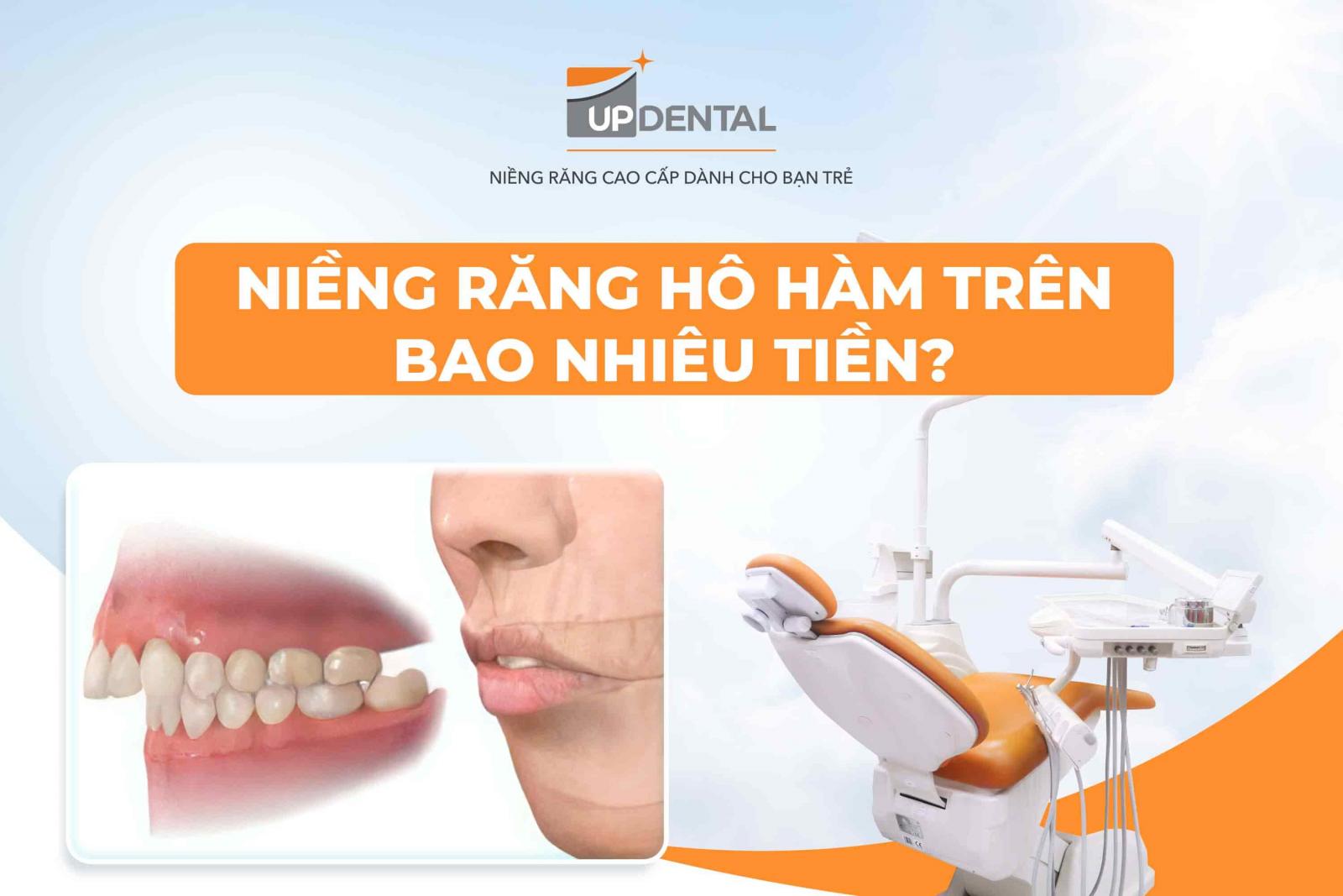 Niềng răng hô hàm trên bao nhiêu tiền?
