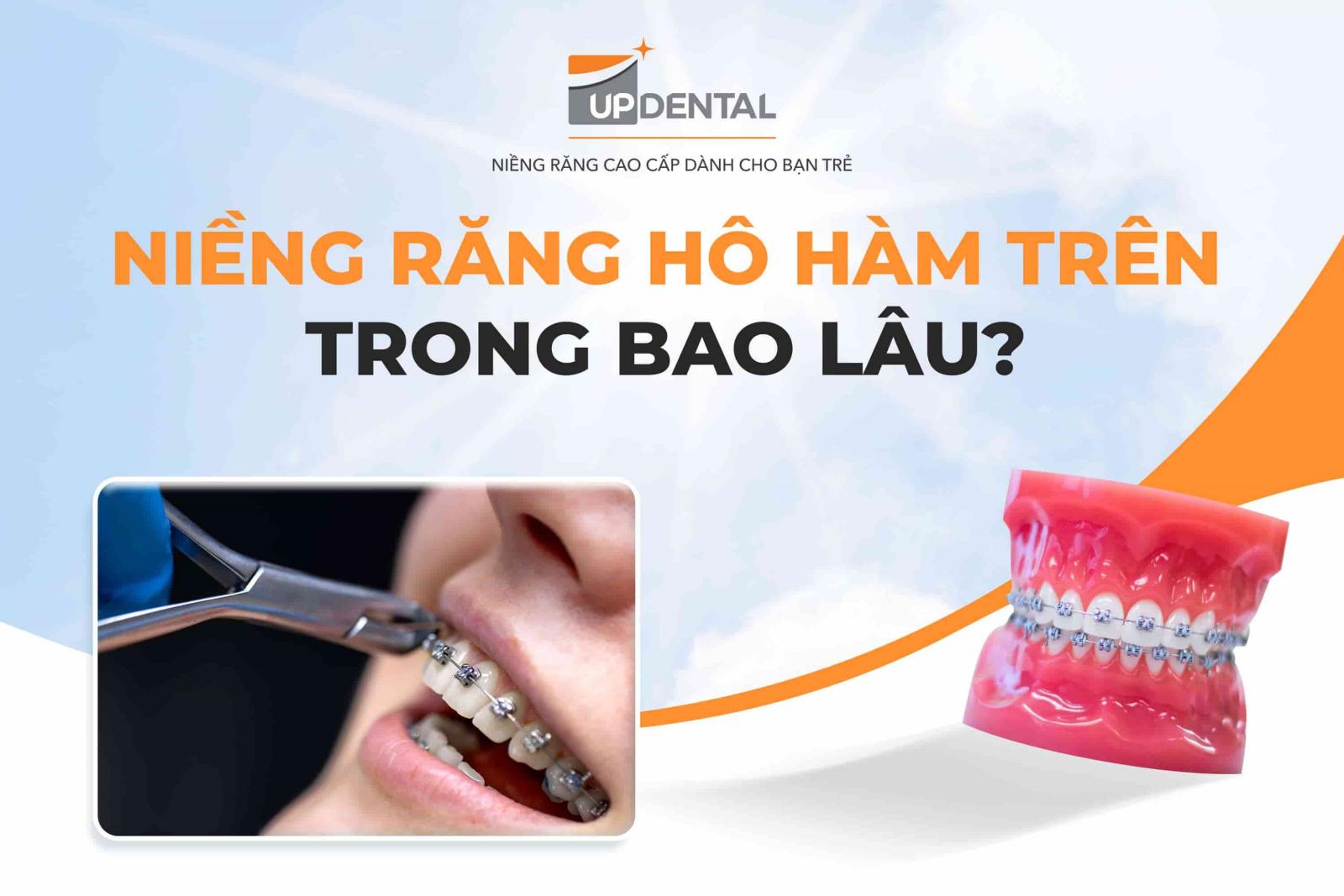 Niềng răng hô hàm trên trong bao lâu?
